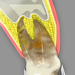 Extractions Emergency Dentistry